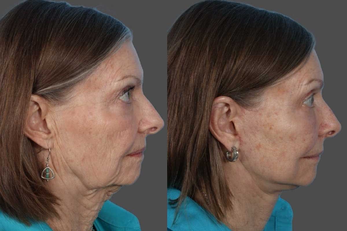 Eyelid Surgery (Blepharoplasty) Before & After Gallery - Patient 110844 - Image 4