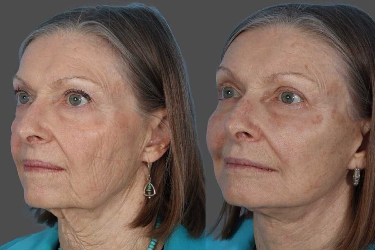 Eyelid Surgery (Blepharoplasty) Before & After Gallery - Patient 110844 - Image 3