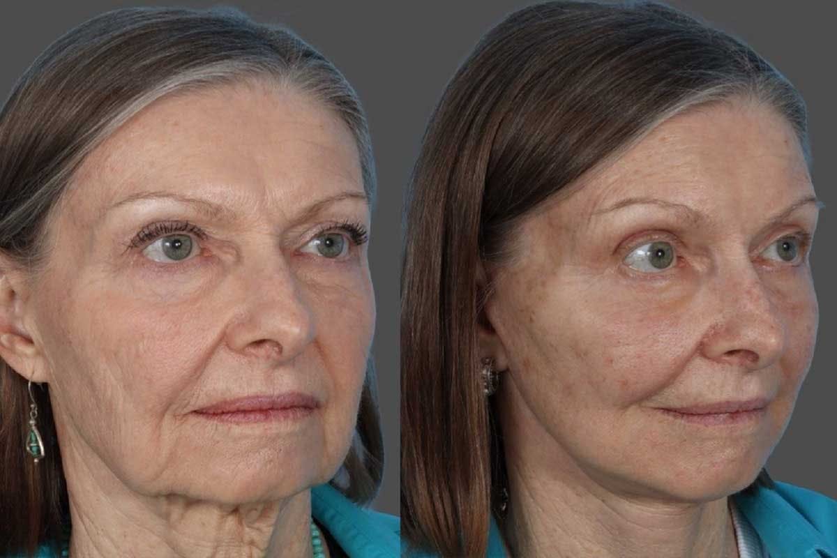 Eyelid Surgery (Blepharoplasty) Before & After Gallery - Patient 110844 - Image 5