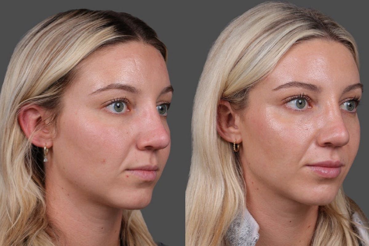 Restylane Before & After Gallery - Patient 245870 - Image 2