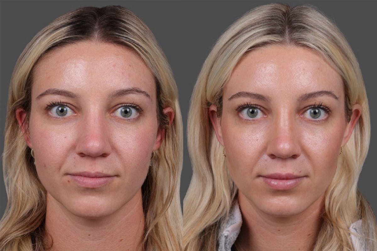 Restylane Before & After Gallery - Patient 245870 - Image 1
