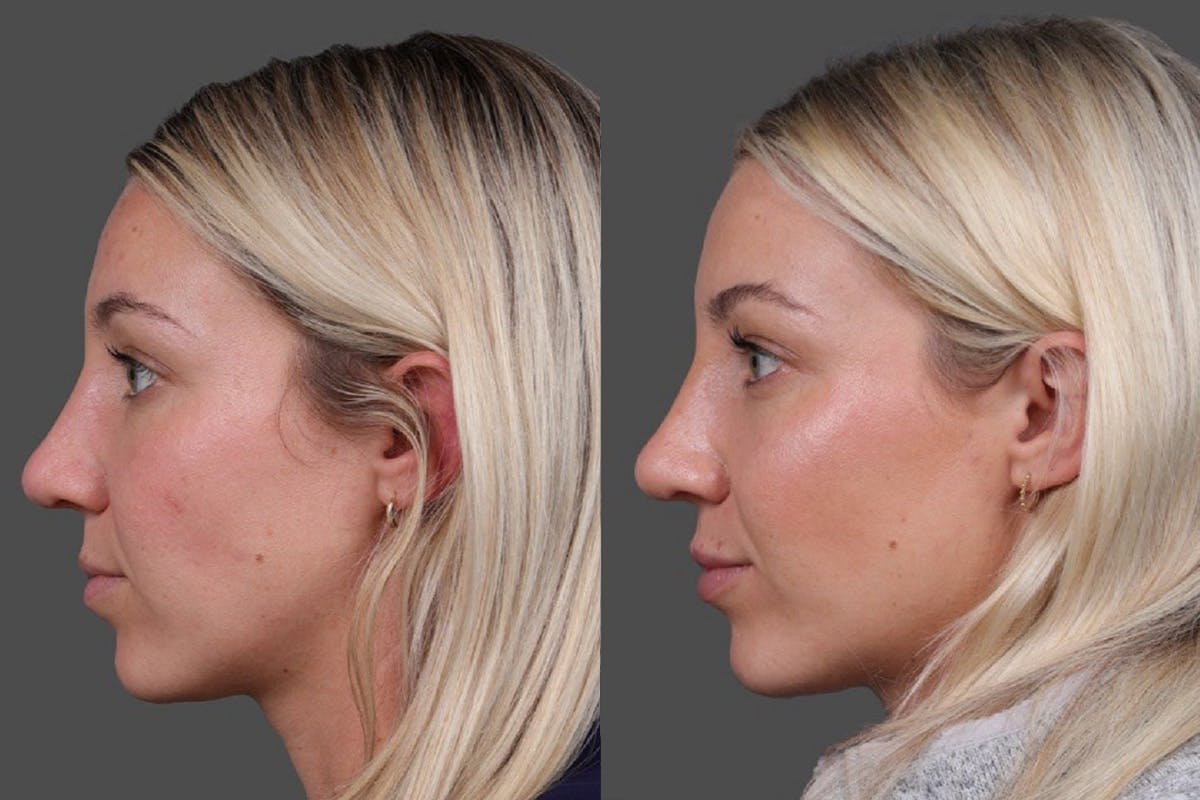 Restylane Before & After Gallery - Patient 245870 - Image 5