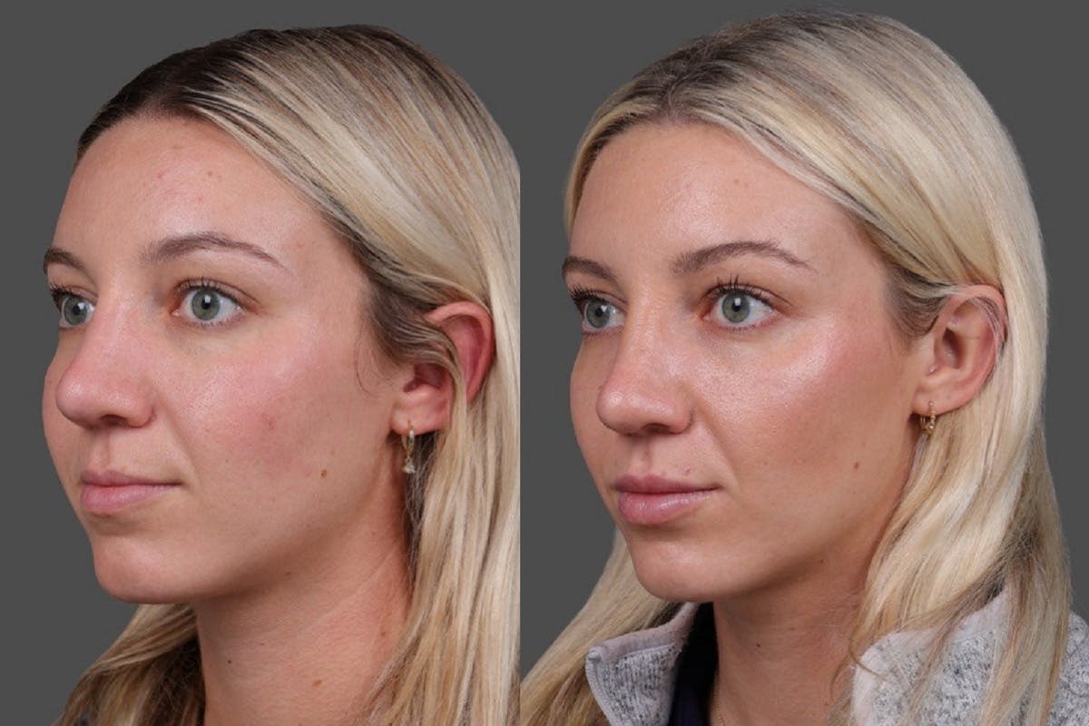 Restylane Before & After Gallery - Patient 245870 - Image 4