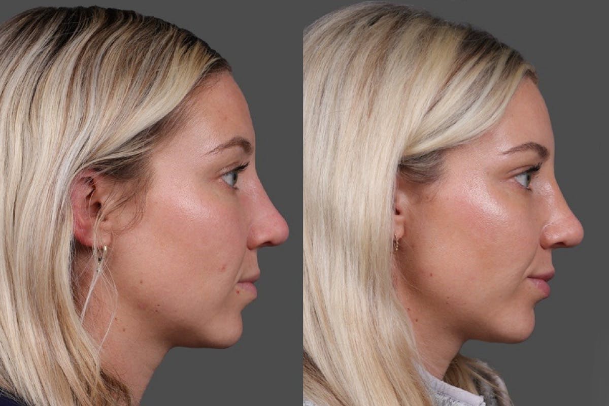 Restylane Before & After Gallery - Patient 245870 - Image 3