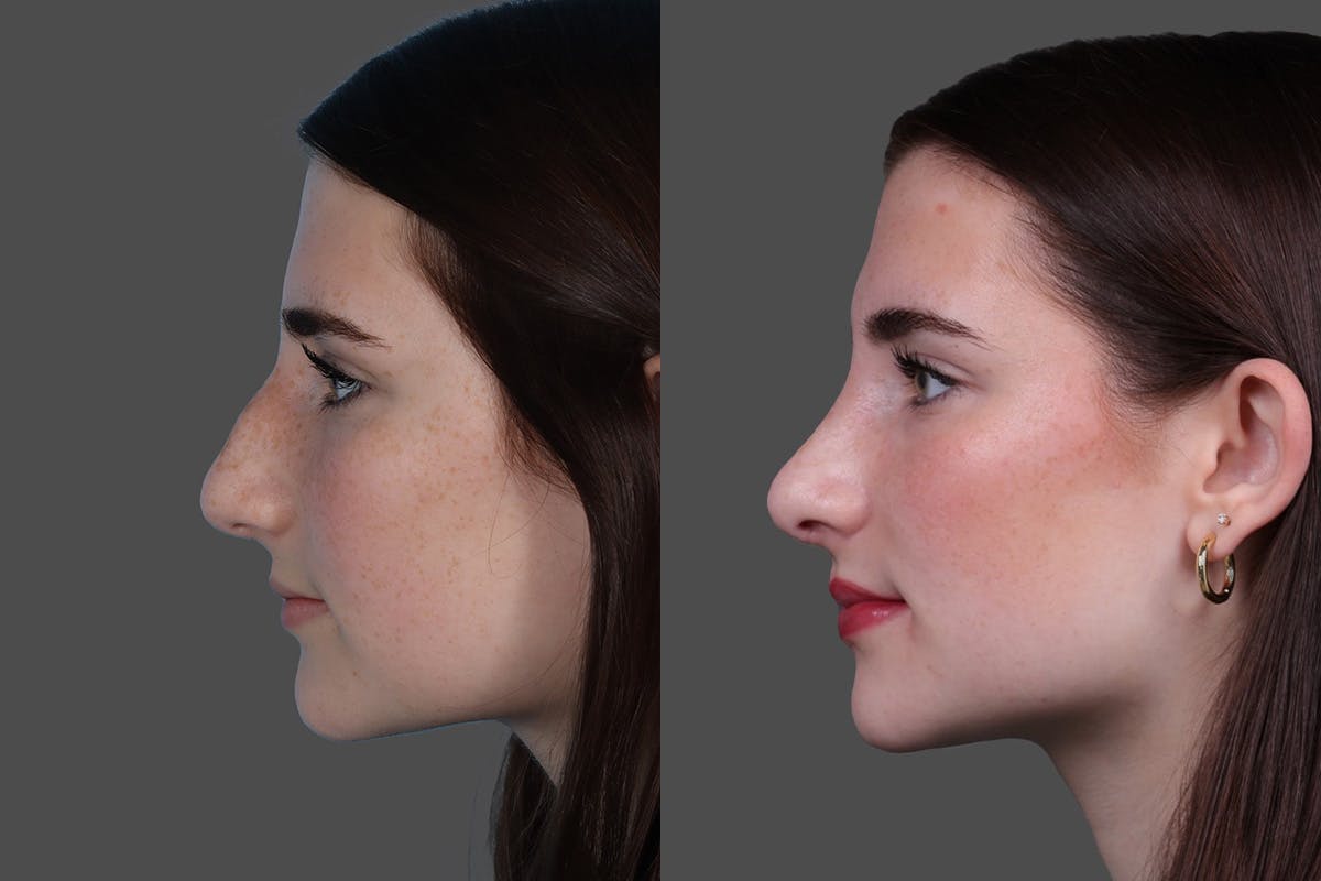 Rhinoplasty Before & After Gallery - Patient 652904 - Image 5