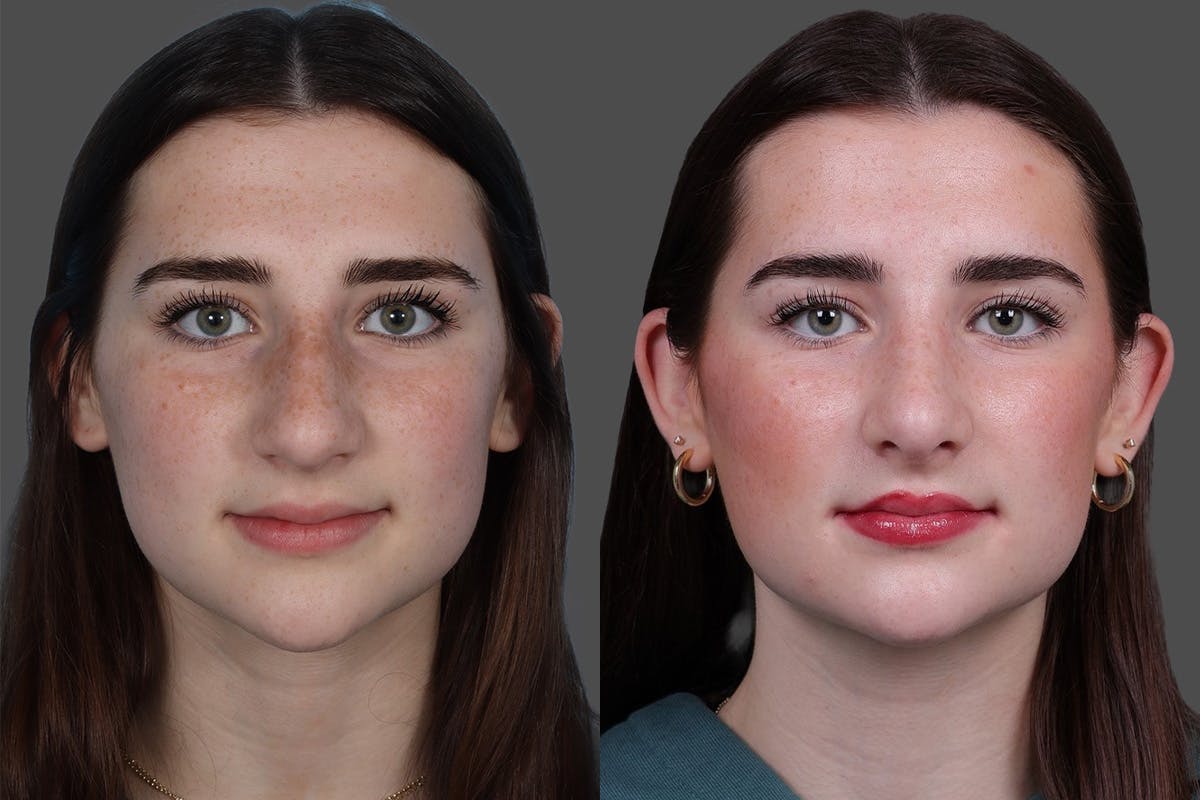Rhinoplasty Before & After Gallery - Patient 652904 - Image 3