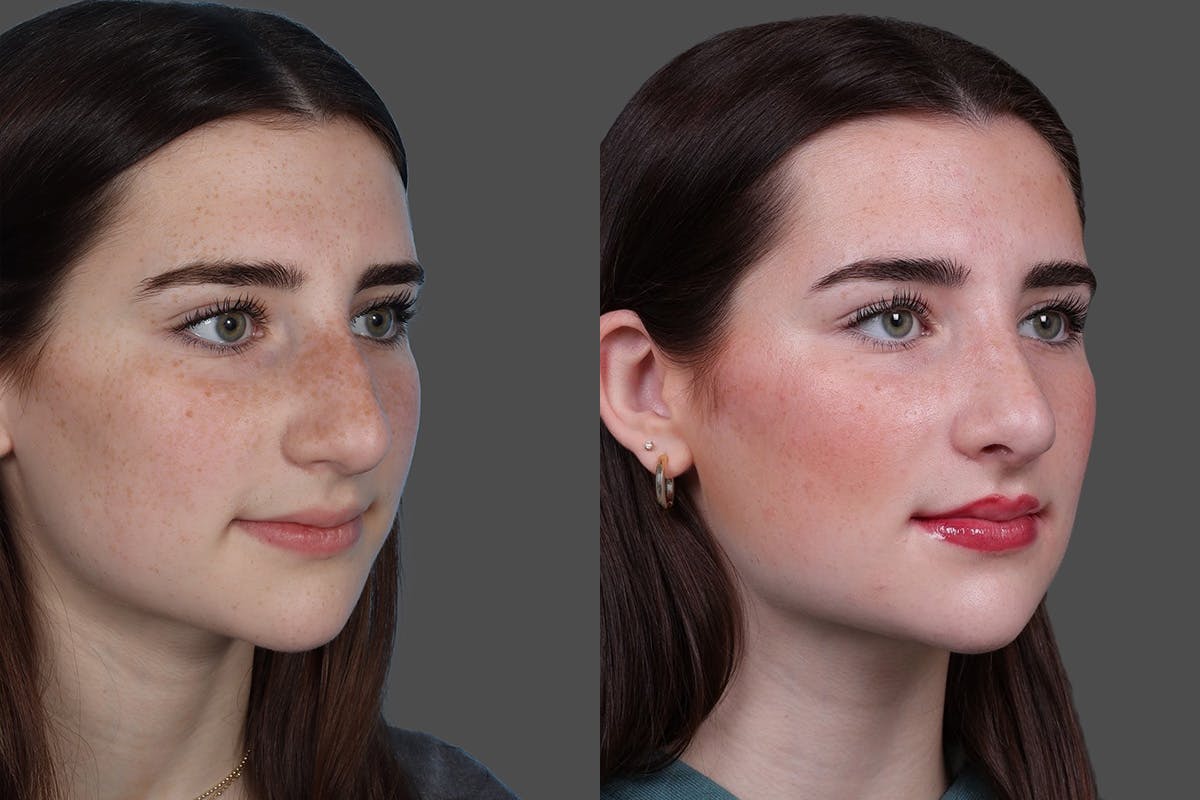 Rhinoplasty Before & After Gallery - Patient 652904 - Image 2