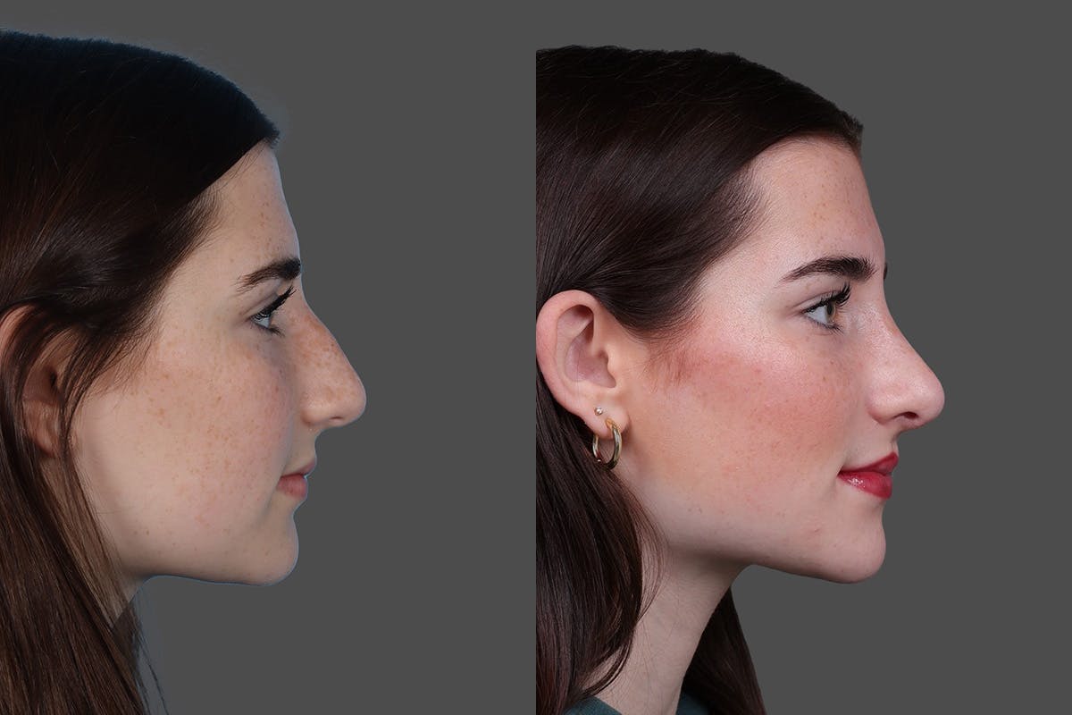 Rhinoplasty Before & After Gallery - Patient 652904 - Image 1