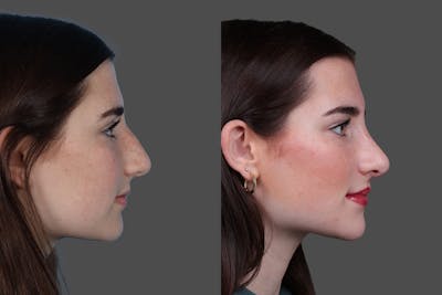 Rhinoplasty Before & After Gallery - Patient 652904 - Image 1