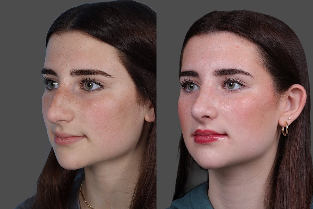 Rhinoplasty Before & After Gallery - Patient 652904 - Image 4
