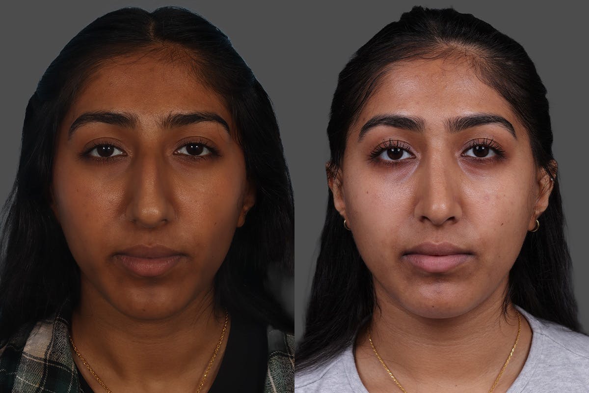 Rhinoplasty Before & After Gallery - Patient 489588 - Image 3