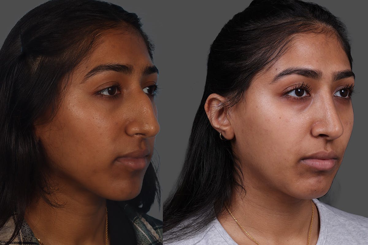 Rhinoplasty Before & After Gallery - Patient 489588 - Image 2