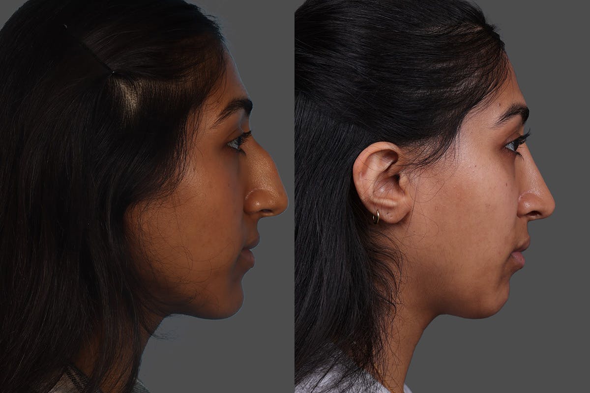 Rhinoplasty Before & After Gallery - Patient 489588 - Image 1