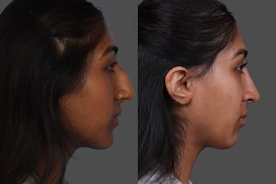 Rhinoplasty Before & After Gallery - Patient 489588 - Image 1