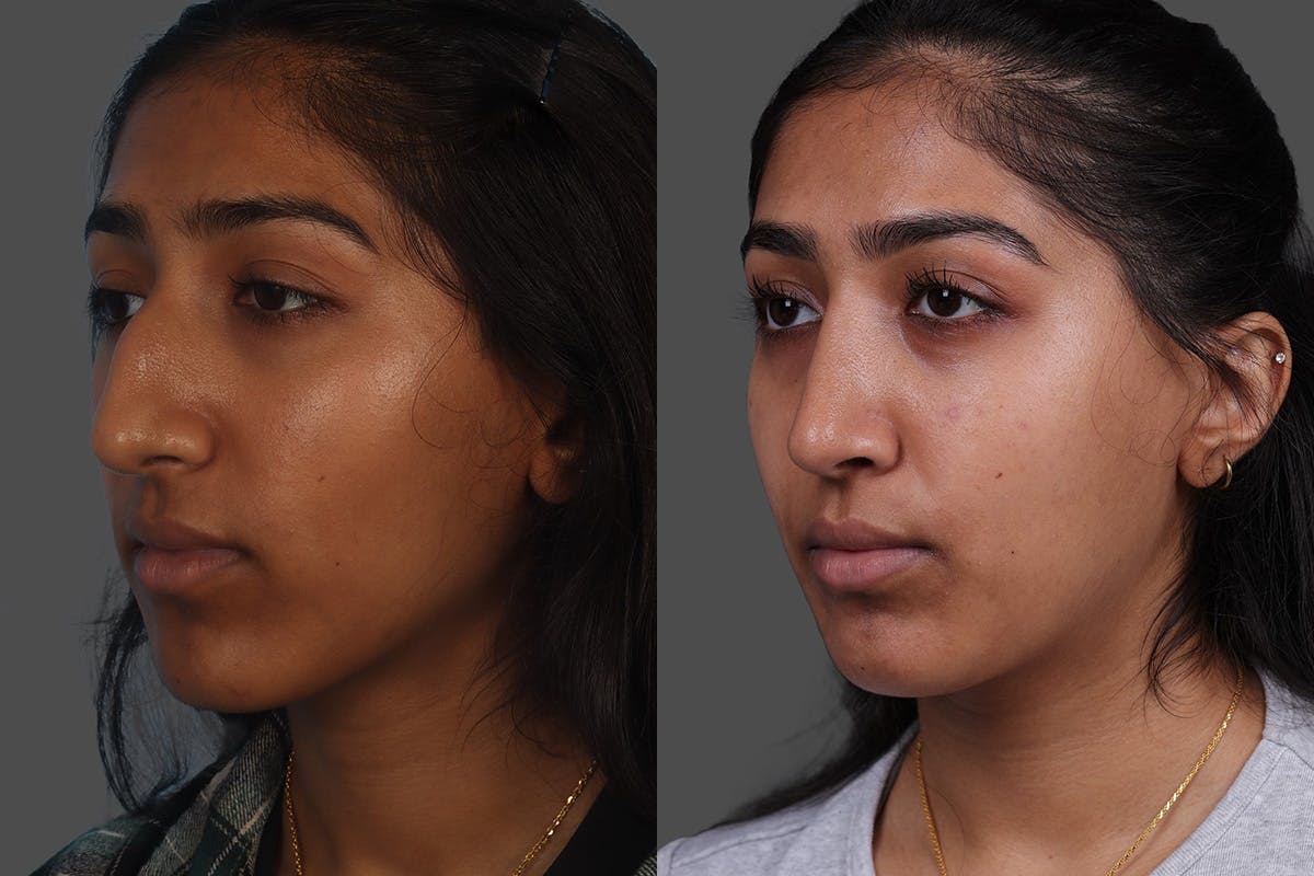 Rhinoplasty Before & After Gallery - Patient 489588 - Image 4