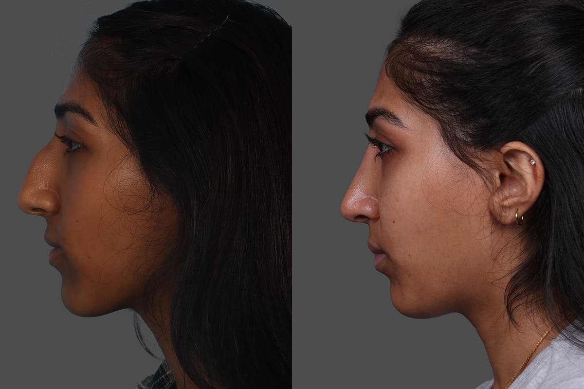 Rhinoplasty Before & After Gallery - Patient 489588 - Image 5