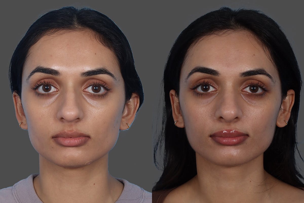 Rhinoplasty Before & After Gallery - Patient 158247 - Image 3