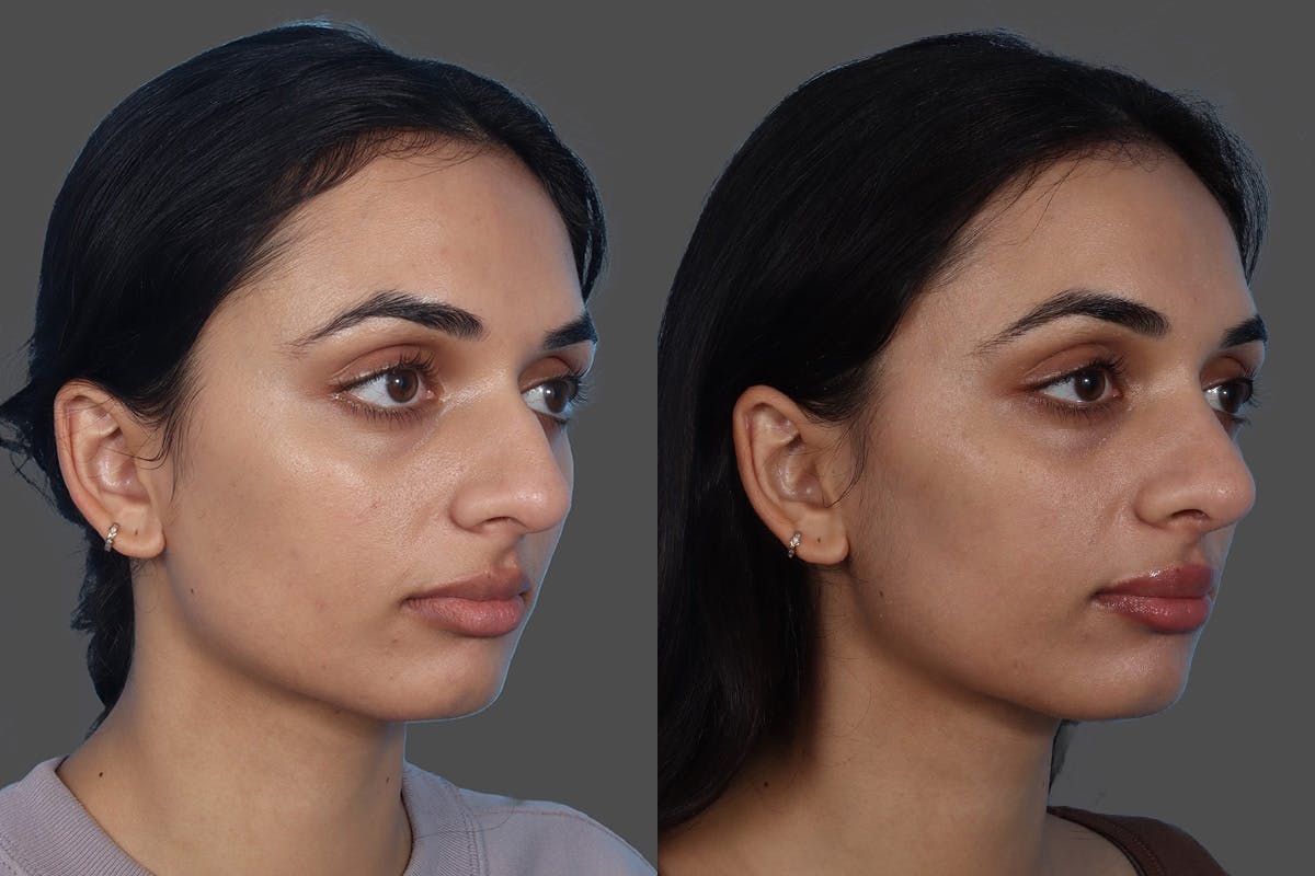 Rhinoplasty Before & After Gallery - Patient 158247 - Image 2