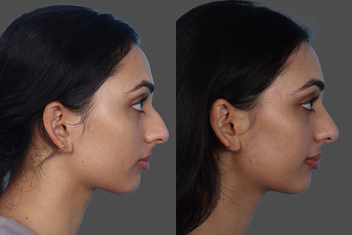Rhinoplasty Before & After Gallery - Patient 158247 - Image 1