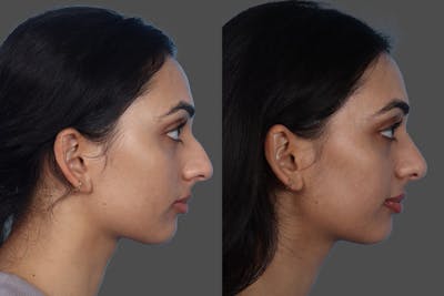 Rhinoplasty Before & After Gallery - Patient 158247 - Image 1