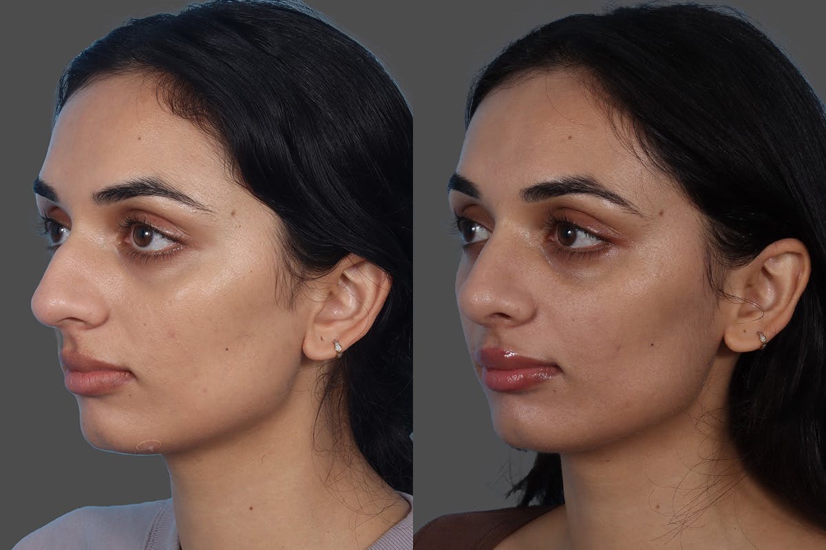 Rhinoplasty Before & After Gallery - Patient 158247 - Image 4