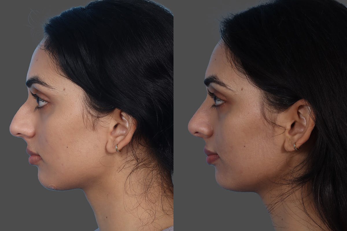 Rhinoplasty Before & After Gallery - Patient 158247 - Image 5