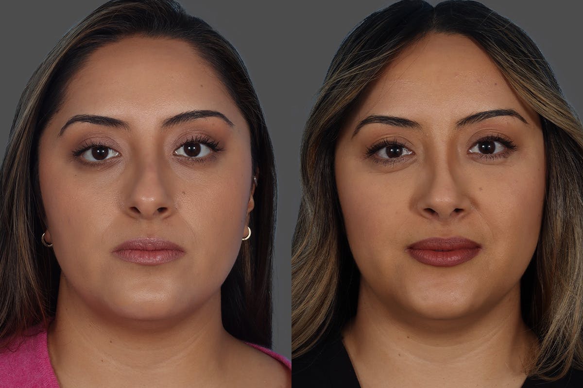 Rhinoplasty Before & After Gallery - Patient 119590 - Image 3