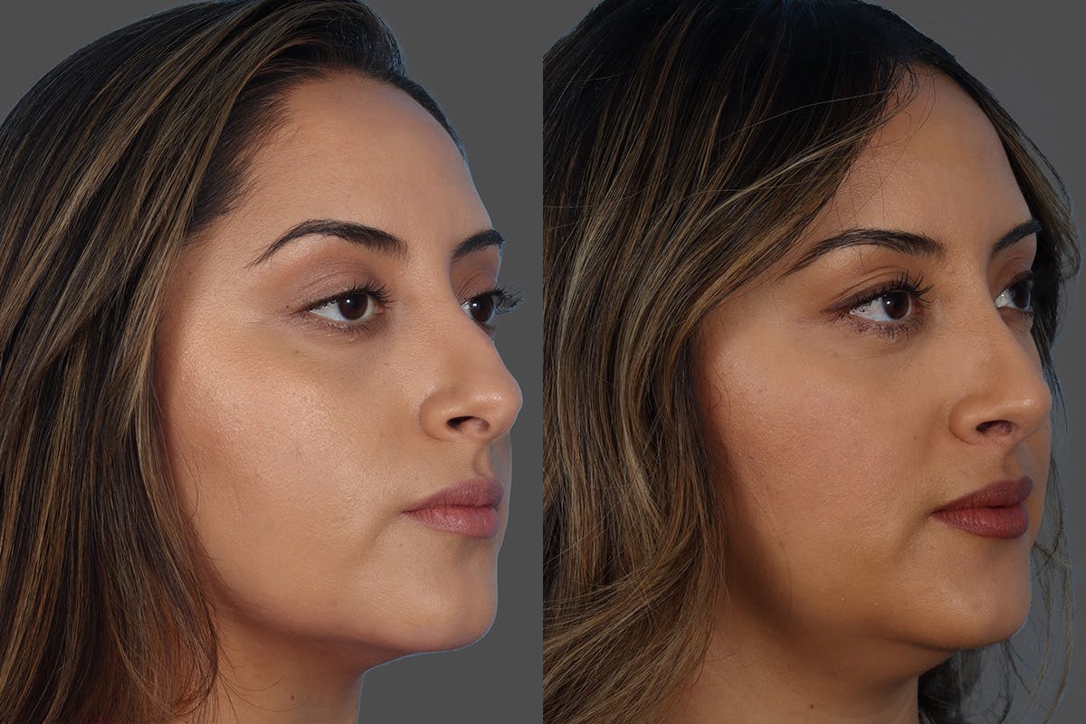 Rhinoplasty Before & After Gallery - Patient 119590 - Image 2