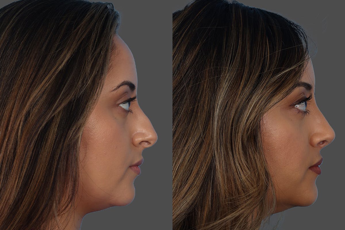 Rhinoplasty Before & After Gallery - Patient 119590 - Image 1