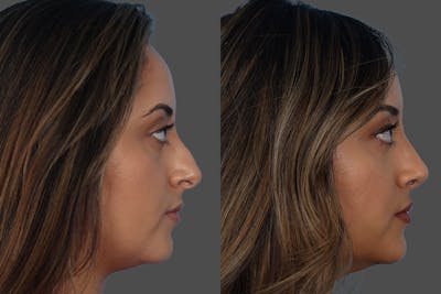 Rhinoplasty Before & After Gallery - Patient 119590 - Image 1