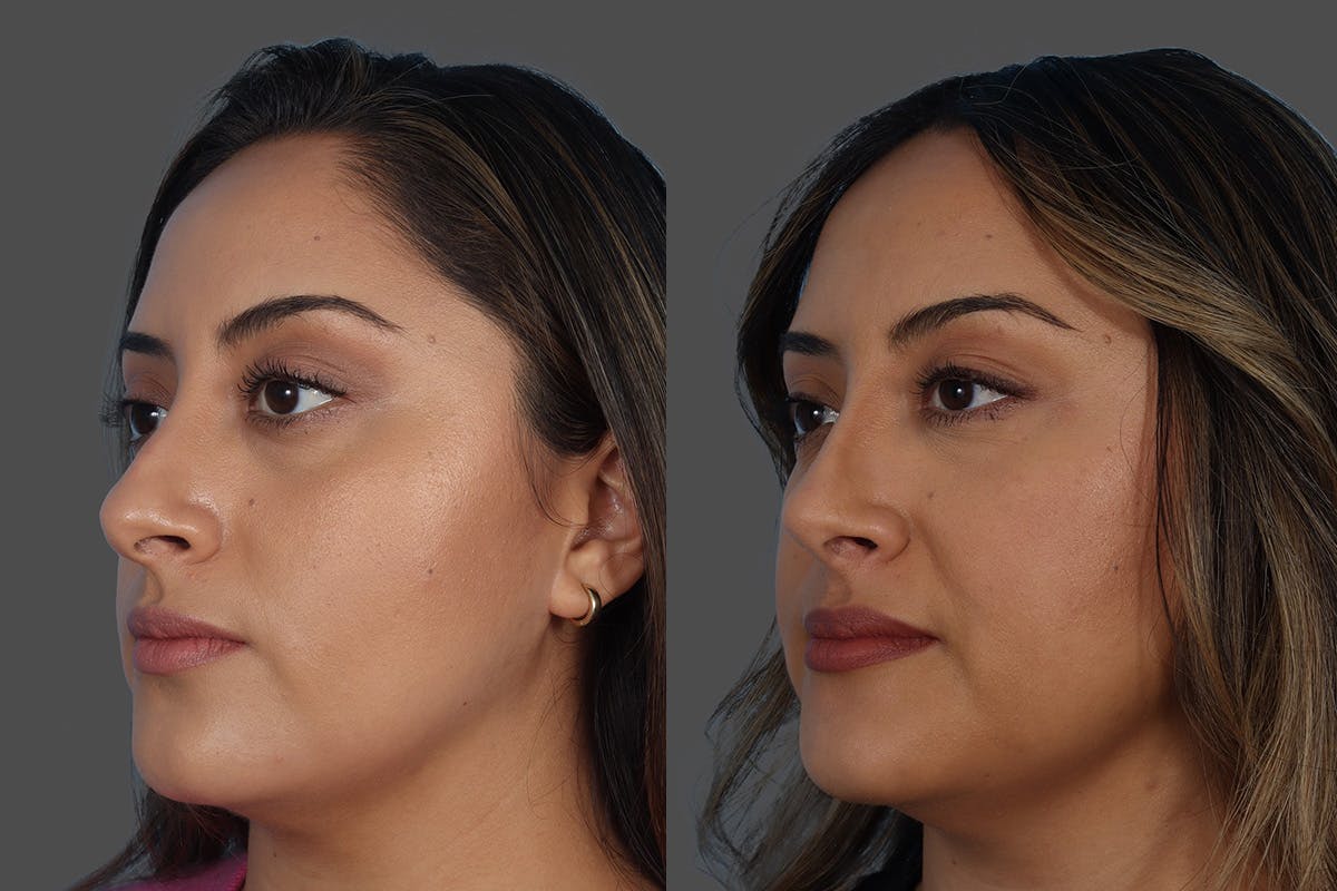 Rhinoplasty Before & After Gallery - Patient 119590 - Image 4
