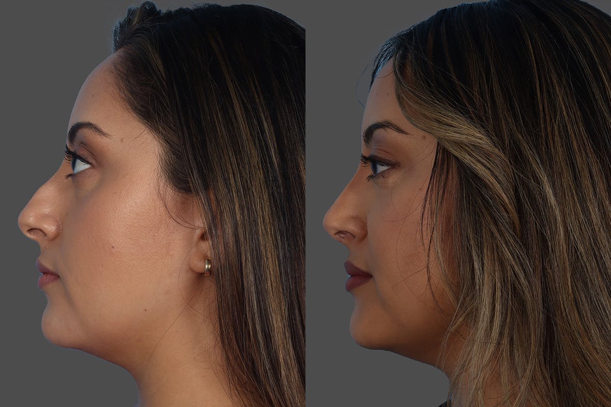 Rhinoplasty Before & After Gallery - Patient 119590 - Image 5