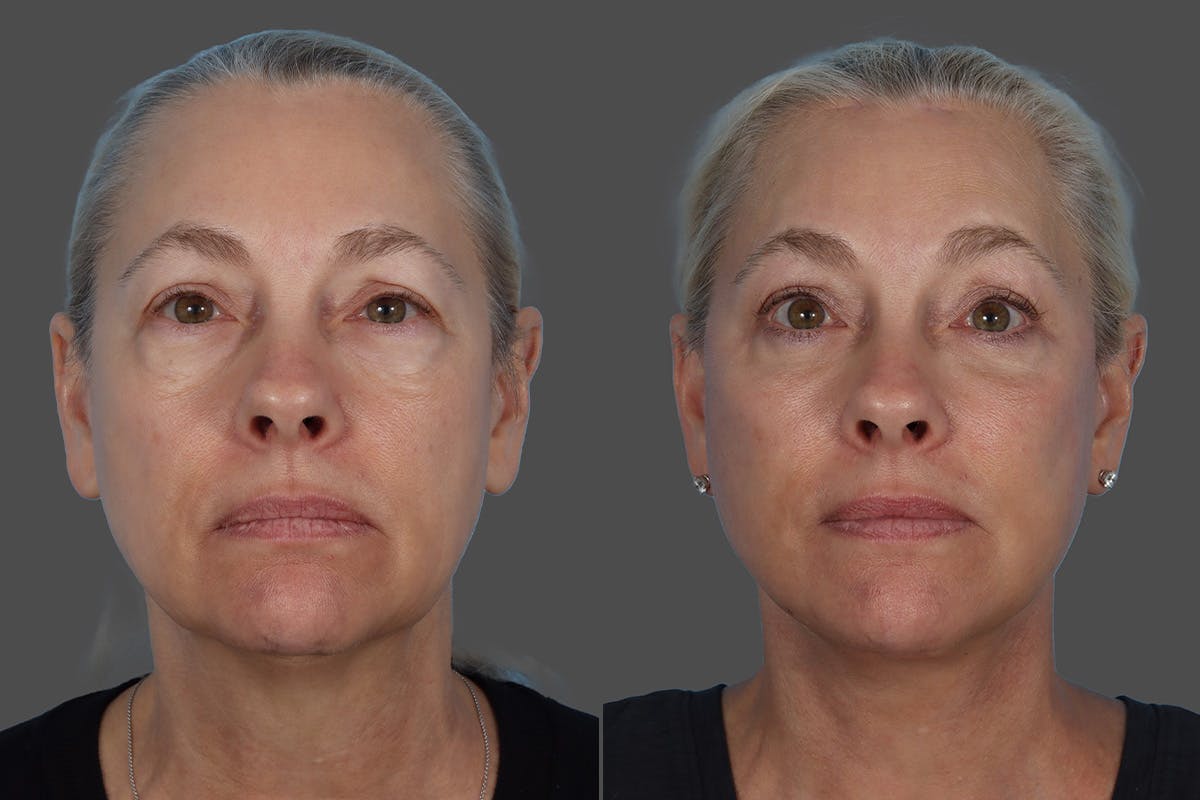 Facial Fat Transfer Before & After Gallery - Patient 253068 - Image 1
