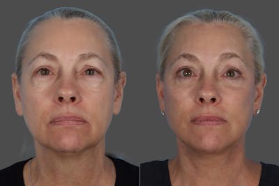 Facial Fat Transfer Before & After Gallery - Patient 253068 - Image 1