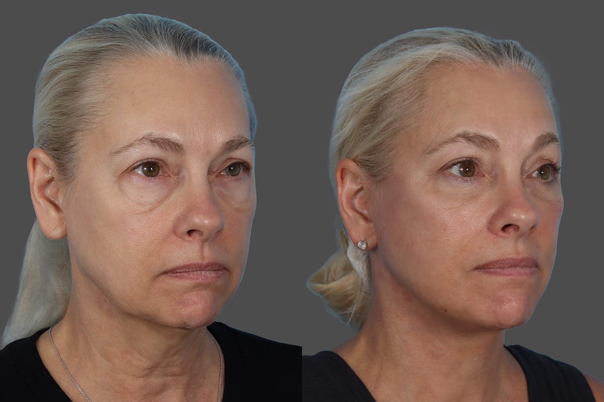 Facial Fat Transfer Before & After Gallery - Patient 253068 - Image 2