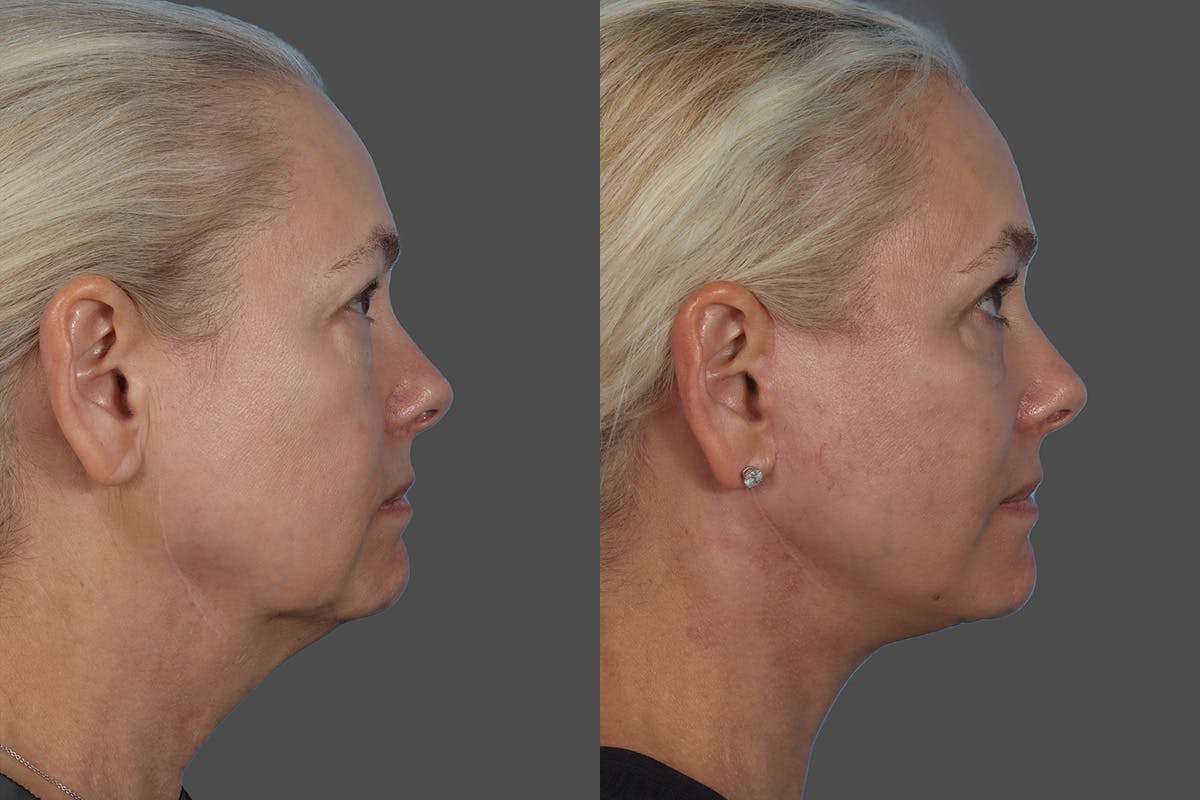 Facial Fat Transfer Before & After Gallery - Patient 253068 - Image 3
