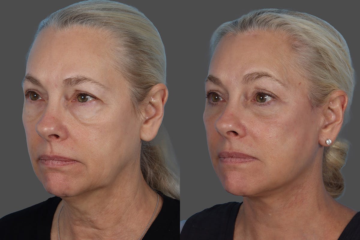Facial Fat Transfer Before & After Gallery - Patient 253068 - Image 4