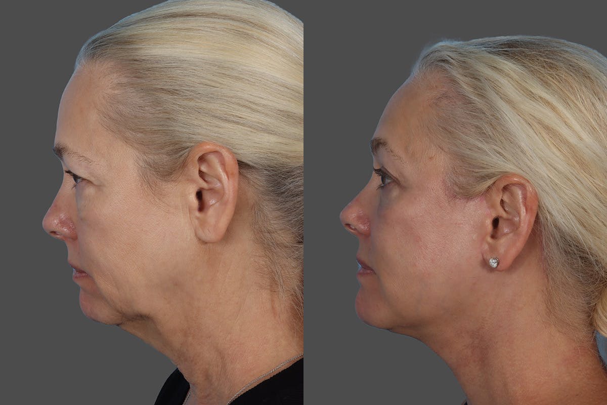 Facial Fat Transfer Before & After Gallery - Patient 253068 - Image 5