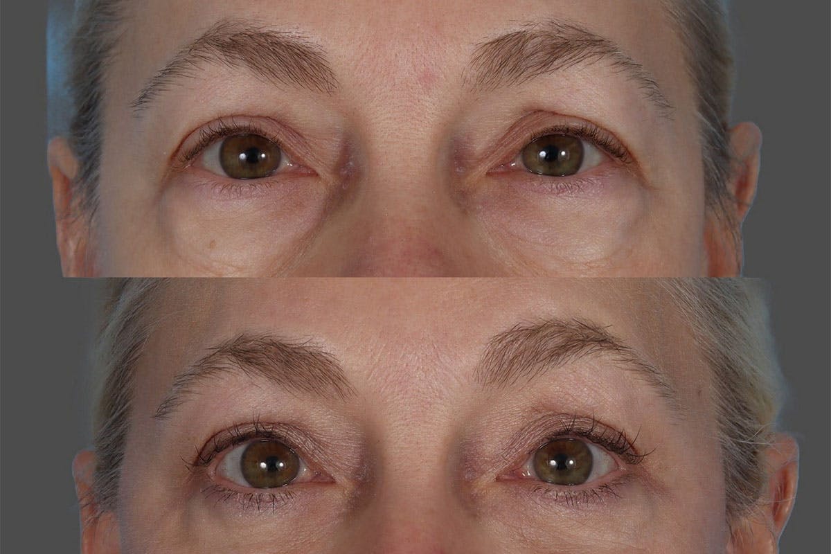 Eyelid Surgery (Blepharoplasty) Before & After Gallery - Patient 385345 - Image 5