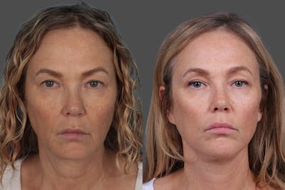 Facelift Before & After Gallery - Patient 247891 - Image 1