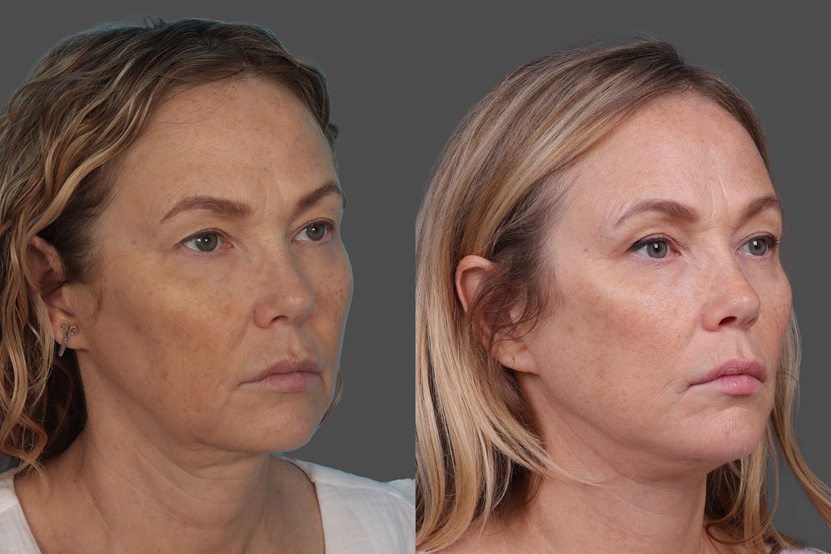 Facelift Before & After Gallery - Patient 247891 - Image 2