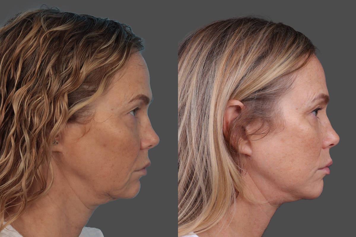 Facelift Before & After Gallery - Patient 247891 - Image 3