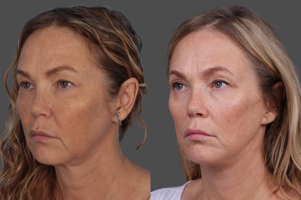 Facelift Before & After Gallery - Patient 247891 - Image 4