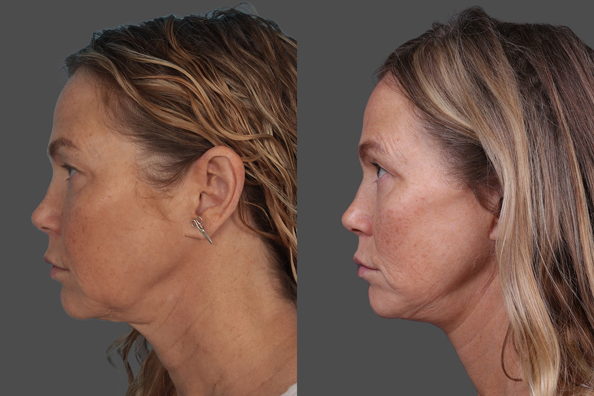 Patient 870376 | Facelift Before & After Photos | Buckingham