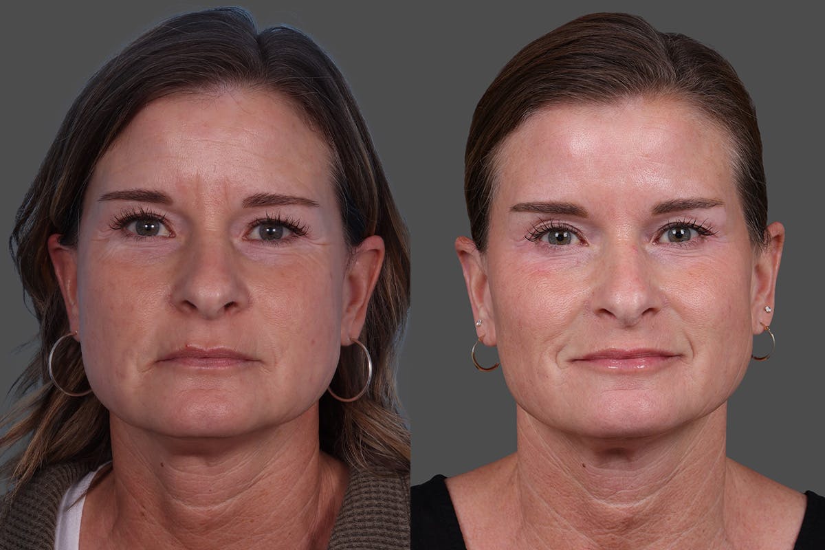 Sculptra Before & After Gallery - Patient 778057 - Image 1