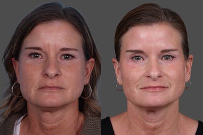 Restylane Before & After Gallery - Patient 398816 - Image 1