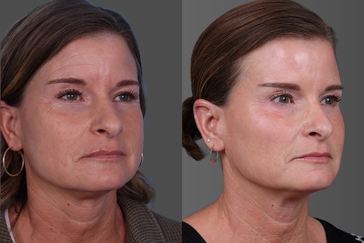 Sculptra Before & After Gallery - Patient 778057 - Image 2