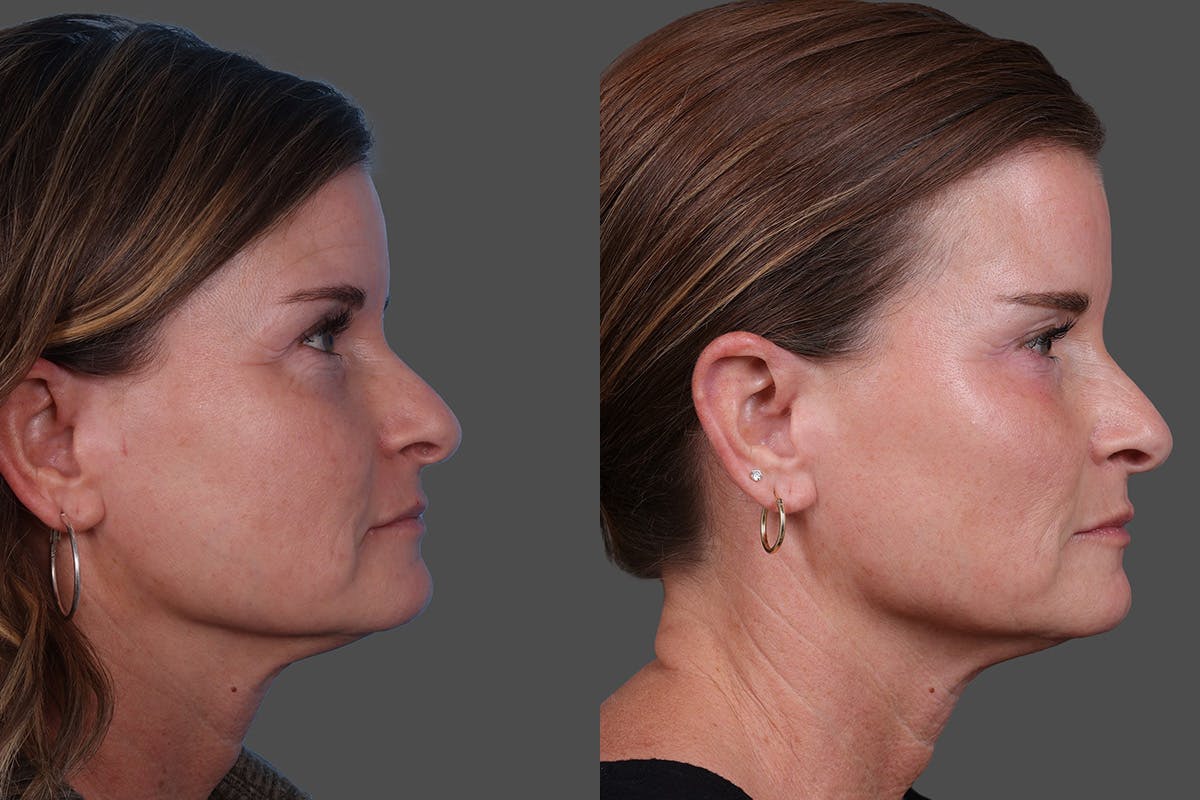 Sculptra Before & After Gallery - Patient 778057 - Image 3