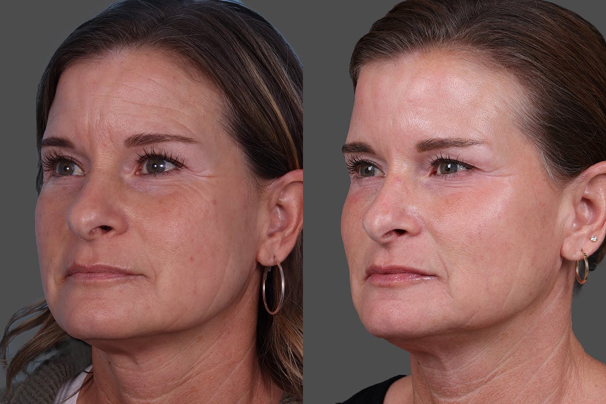 Sculptra Before & After Gallery - Patient 778057 - Image 4