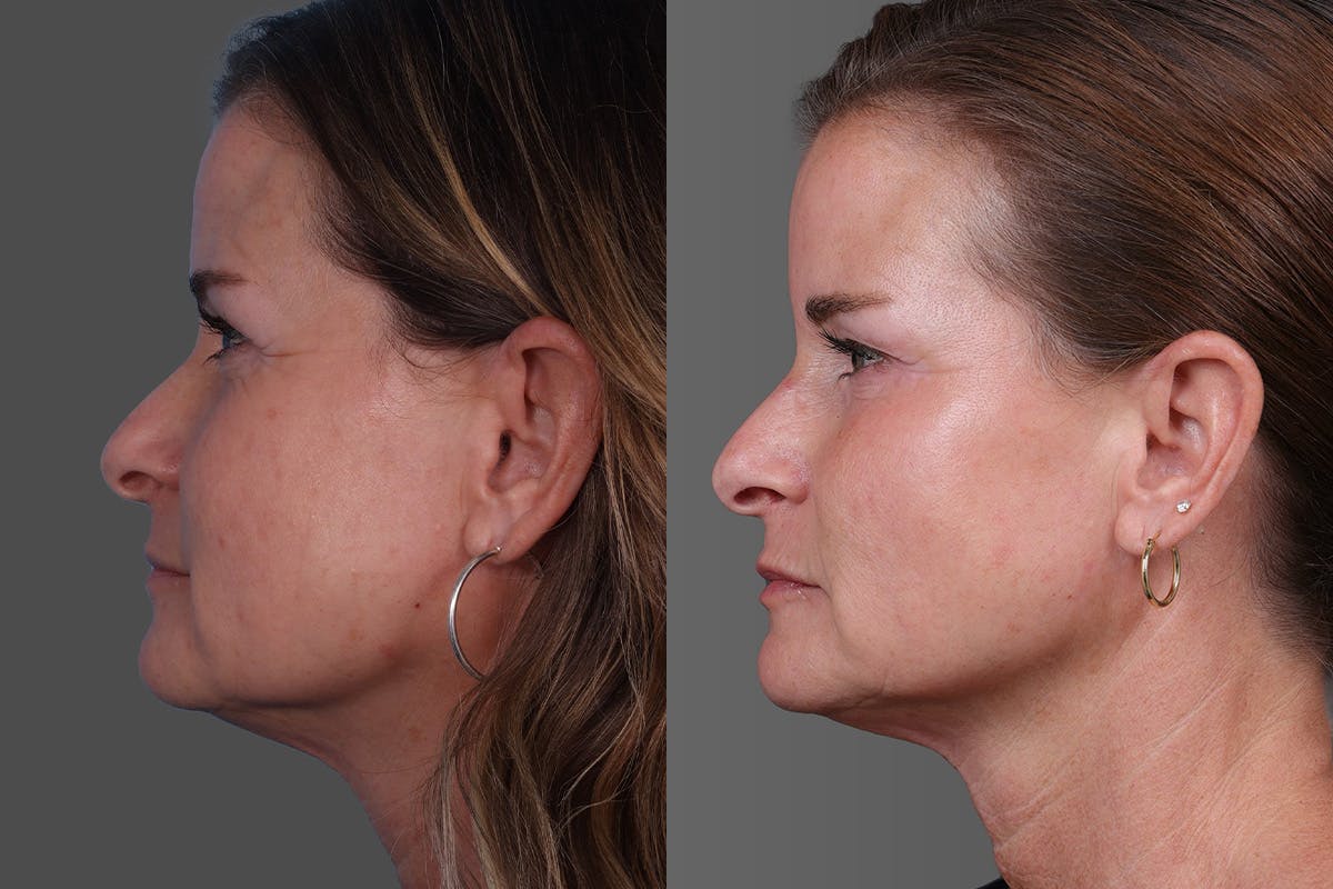 Sculptra Before & After Gallery - Patient 778057 - Image 5
